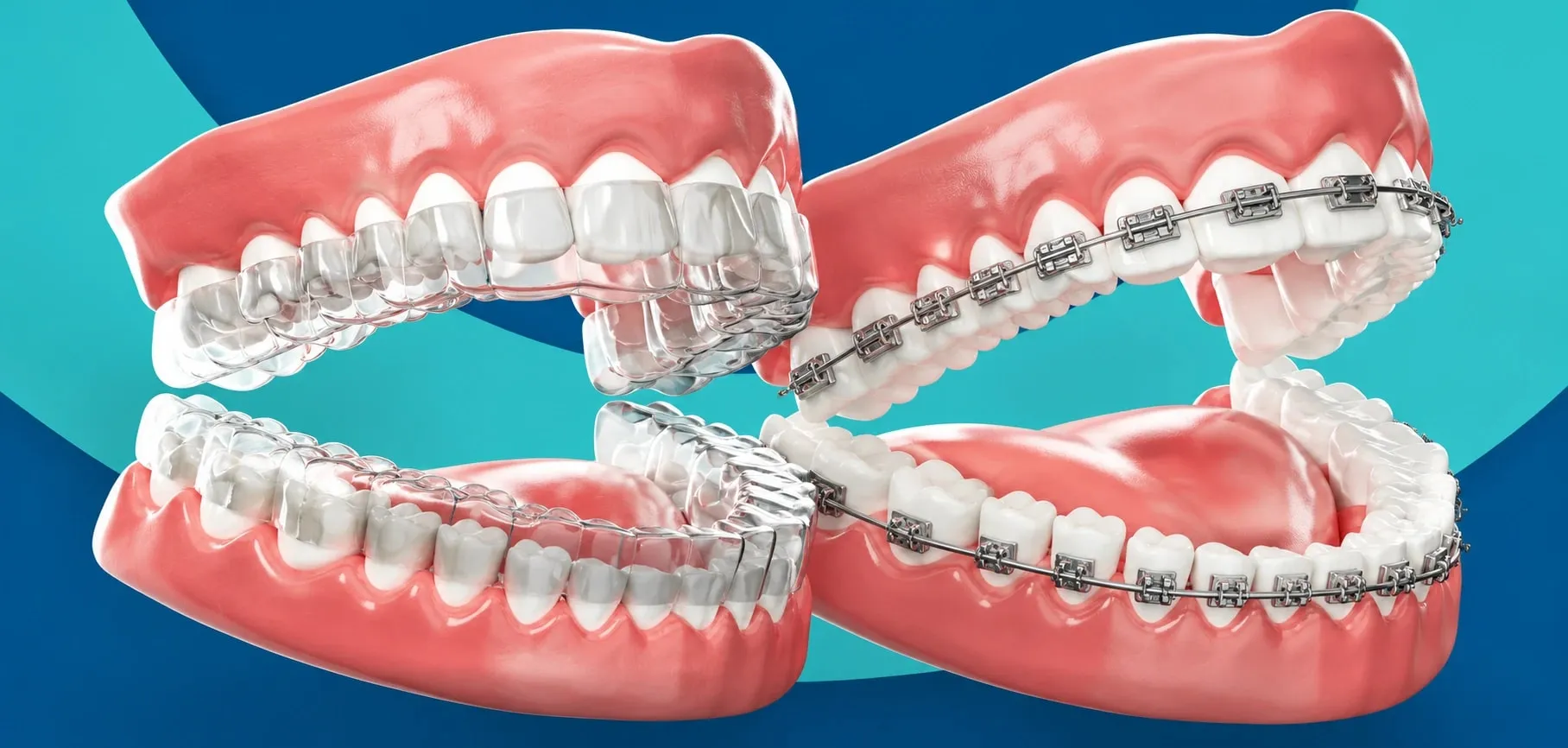Model of teeth with clear aligners next to a model with metal braces