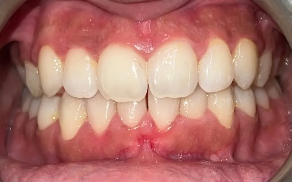 Meno a le mangwe morago ga kalafi ya orthodontics, a tlhomame sentle
