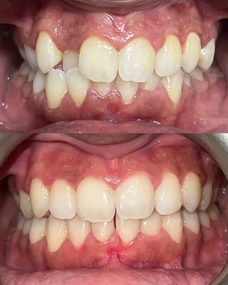 Teeth after orthodontic treatment, evenly aligned